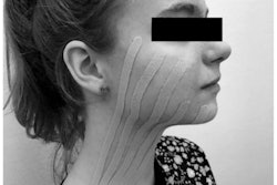 The taping method used on one of the third-molar extraction patients.