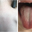 A patient with scarlet fever and a (A) sandpaper-like skin rash on the back and (B) a strawberry-like appearance of the tongue.