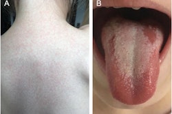 A patient with scarlet fever and a (A) sandpaper-like skin rash on the back and (B) a strawberry-like appearance of the tongue.