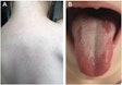 A patient with scarlet fever and a (A) sandpaper-like skin rash on the back and (B) a strawberry-like appearance of the tongue.