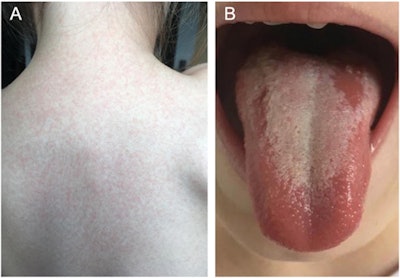 A patient with scarlet fever and a (A) sandpaper-like skin rash on the back and (B) a strawberry-like appearance of the tongue.