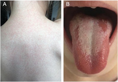 What is Scarlet Fever?