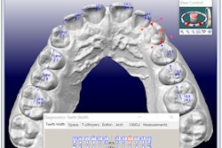 3D model shown in the OrthoCAD software program illustrating the diagnostic tool used to measure the widths of mesiodistal teeth.