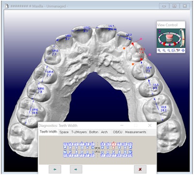 3D model shown in the OrthoCAD software program illustrating the diagnostic tool used to measure the widths of mesiodistal teeth.