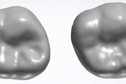 Natural tooth (left) compared with a tooth tailored generated by AI (right).