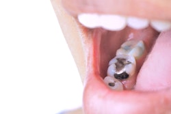 Amalgam Filling