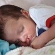 Baby Cleft Lip