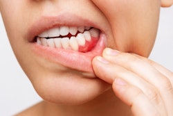 Gum Inflammation