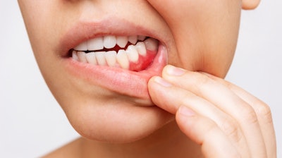 Gum Inflammation