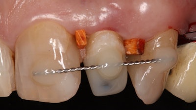 A wire splint affixed to the treated tooth.