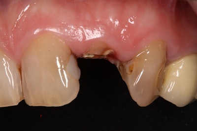 A patient's isogingivally fractured maxillary lateral incisor.