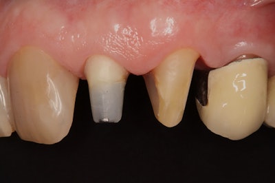 After the stabilization phase, final preparations were made for definitive restorations.