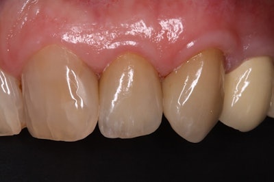 The patient's smile at a 55.8-month follow-up visit.