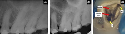 (A, B) The preoperative intraoral x-ray of the man’s maxillary left second molar. (C) Pulp chamber floor of the tooth showing the presence of an additional orifice in close approximation relation to the palatal (P) orifice and subsequent gouging in the distobuccal region adjacent to the mesiobuccal (MB) orifice.
