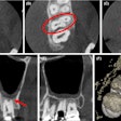 (A-C) Axial CBCT images in the cervical, middle, and apical region of the man’s molar. (D) The coronal section showed the apical split of roots and early periapical radiolucency in the palatal root (red arrow). (E) The sagittal section shows the gouging of the floor.
