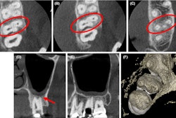 (A-C) Axial CBCT images in the cervical, middle, and apical region of the man’s molar. (D) The coronal section showed the apical split of roots and early periapical radiolucency in the palatal root (red arrow). (E) The sagittal section shows the gouging of the floor.