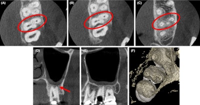 (A-C) Axial CBCT images in the cervical, middle, and apical region of the man’s molar. (D) The coronal section showed the apical split of roots and early periapical radiolucency in the palatal root (red arrow). (E) The sagittal section shows the gouging of the floor.