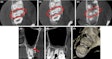(A-C) Axial CBCT images in the cervical, middle, and apical region of the man’s molar. (D) The coronal section showed the apical split of roots and early periapical radiolucency in the palatal root (red arrow). (E) The sagittal section shows the gouging of the floor.