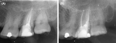 (A) Patient x-ray immediately after surgery. (B) Patient x-ray one year after surgery.