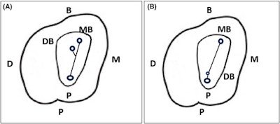 (A) An illustration of the typical location of the distobuccal (DB) root canal orifice in relation to the mesiobuccal (MB) and palatal (P) root canal orifices. (B) An illustration of the unusual location of the DB root canal in close approximation of the P root canal. (B, buccal; D, distal; M, mesial.)