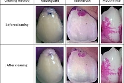 Images comparing tooth surfaces cleaned using a mouthguard, toothbrush, and mouth rinse.