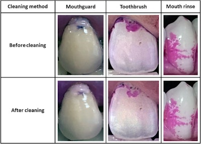 Images comparing tooth surfaces cleaned using a mouthguard, toothbrush, and mouth rinse.