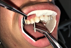 Researchers will collect a sample of oral bacteria from study participants.