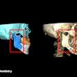 Intraoral vertical ramus osteotomy (IVRO): (Left) The preoperative virtual surgical planning (red frame). (Right) The postoperative CT scan (red frame).