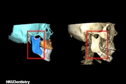Intraoral vertical ramus osteotomy (IVRO): (Left) The preoperative virtual surgical planning (red frame). (Right) The postoperative CT scan (red frame).