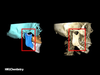 Intraoral vertical ramus osteotomy (IVRO): (Left) The preoperative virtual surgical planning (red frame). (Right) The postoperative CT scan (red frame).
