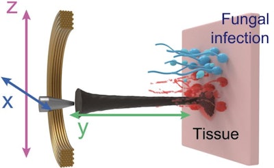 Electromagnetic cores precisely guide the array of nanozyme bots as they target the site of fungal infection.