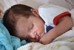Baby Cleft Lip