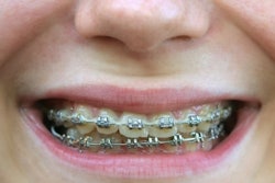 Braces