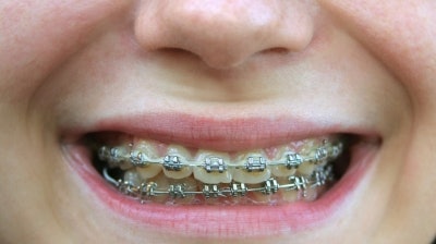 Braces