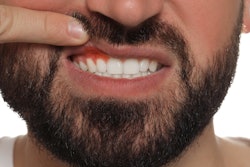 Inflamed Gums Man
