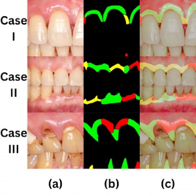 Three cases illustrating a dentist's visual examination and AI's detection of gum problems. (a) Intraoral photograph, (b) health status labeled by a calibrated dentist (green = healthy, red = diseased, yellow = questionable), (c) AI detection results.