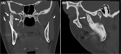 CT in the (A) frontal and (B) sagittal view shows ossification of the woman's right temporal muscle attachment extending to the cranial base (arrows). Images courtesy of Pedersen et al. Licensed by CC BY 4.0.