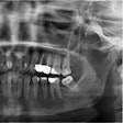 The (A) panoramic x-ray after surgical treatment shows partial resection of the lesion and the coronoid process (arrow). A (B) clinical image of the resected lesion.