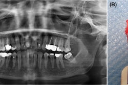The (A) panoramic x-ray after surgical treatment shows partial resection of the lesion and the coronoid process (arrow). A (B) clinical image of the resected lesion.
