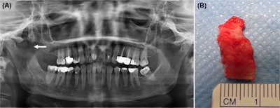 The (A) panoramic x-ray after surgical treatment shows partial resection of the lesion and the coronoid process (arrow). A (B) clinical image of the resected lesion.