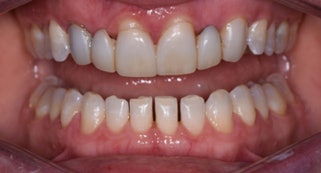 An intraoral image taken after seven months of Invisalign treatment.