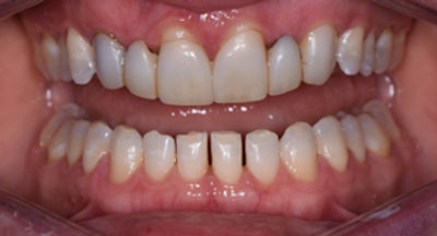 An intraoral image taken after seven months of Invisalign treatment.