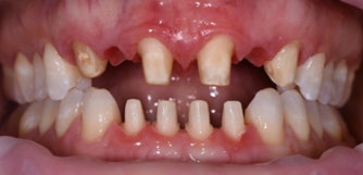 Following minimally invasive preparations, the patient was then fitted with 3D-printed provisionals.