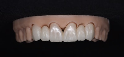 The Katana Zirconia One bridge (teeth # 6-8 and #9-11) shown on a model after contouring/preglaze.