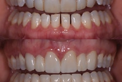 Preop (top) and postop (bottom) of the patient. All images courtesy of Dr. Jenny Apekian.