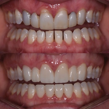 Preop (top) and postop (bottom) of the patient. All images courtesy of Dr. Jenny Apekian.