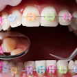 Braces Color Bands