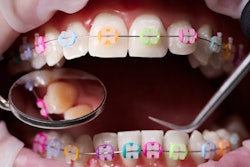 Braces Color Bands