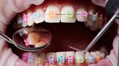 Braces Color Bands