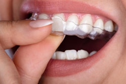 Clear Aligner Woman